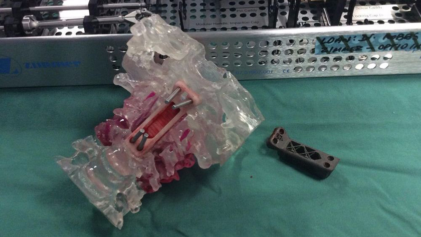 Пациенту успешно имплантировали напечатанные на 3D-принтере позвонки