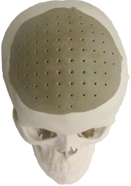 В США проведена операция по замене 75% черепа имплантом, напечатанным на 3D-принтере