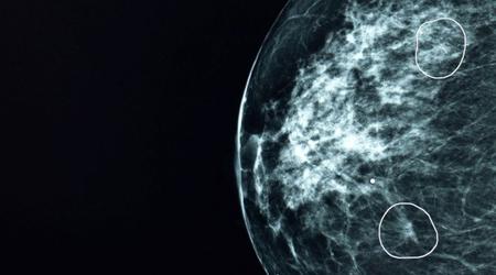 I Storbritannia har kunstig intelligens bidratt til å oppdage brystkrefttilfeller som legene har gått glipp av.
