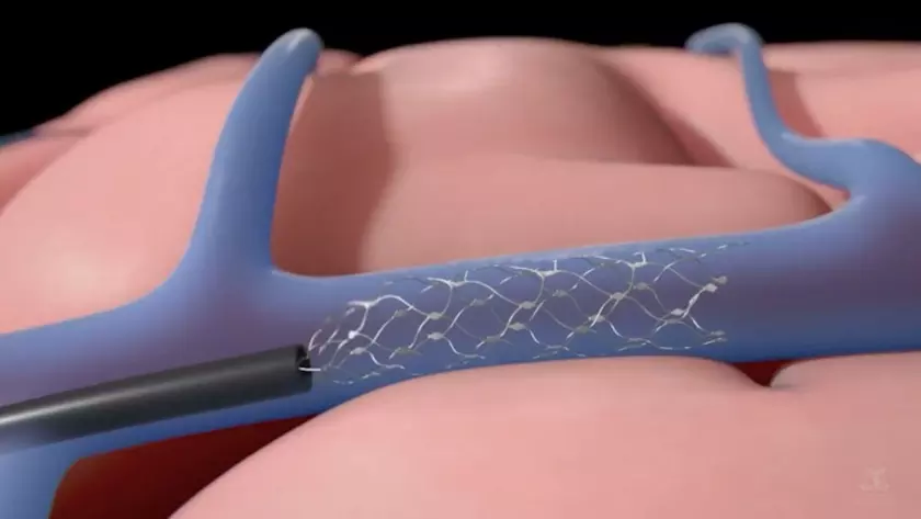 Конкурент Neuralink получил разрешение на тестирование на людях