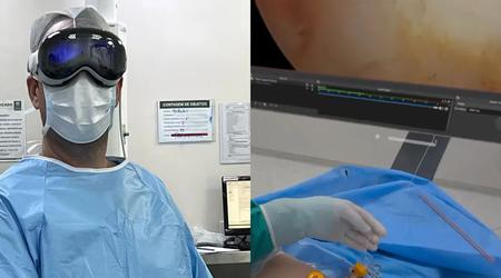 Apple Vision Pro aiuta i medici in Brasile: Cuffie innovative utilizzate durante l'artroscopia della spalla