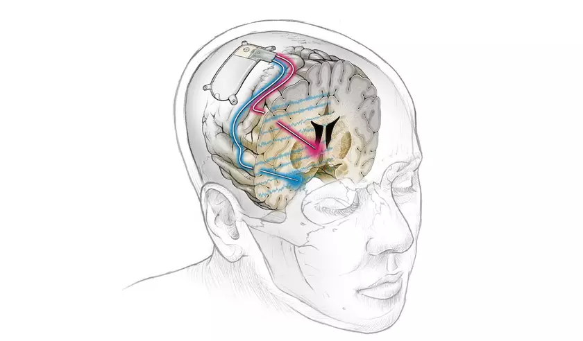 Первый в мире мозговой имплантат успешно лечит устойчивую депрессию у пациента