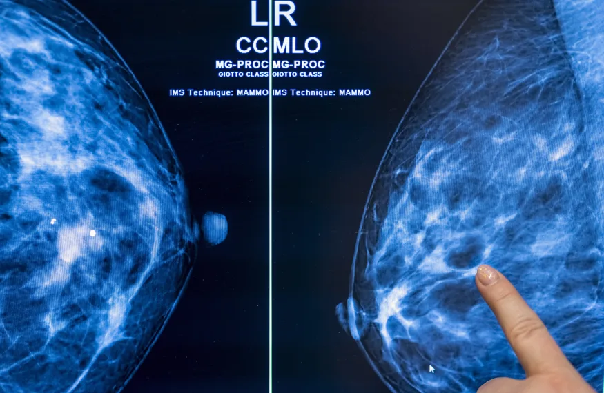 Cancer screening with artificial intelligence could halve radiologists' workload - study