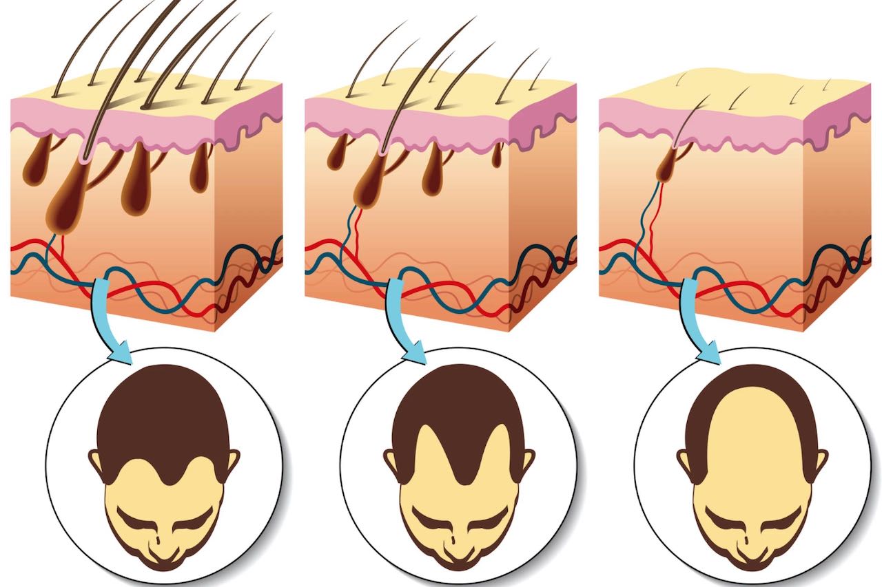 Micro-needle patch beats baldness by increasing blood flow to the follicles