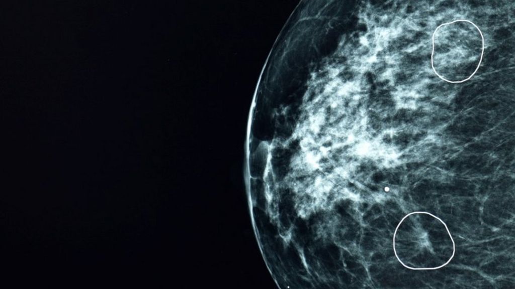 En Gran Bretaña, la IA ha ayudado a detectar casos de cáncer de mama pasados por alto por los médicos