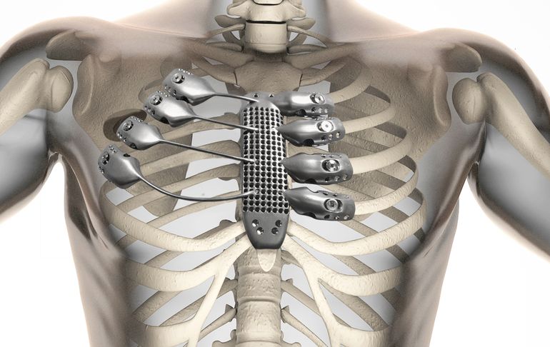 Врачи пересадили пациенту напечатанные на 3D-принтере титановые ребра и грудину