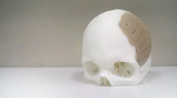 В США проведена операция по замене 75% черепа имплантом, напечатанным на 3D-принтере-2